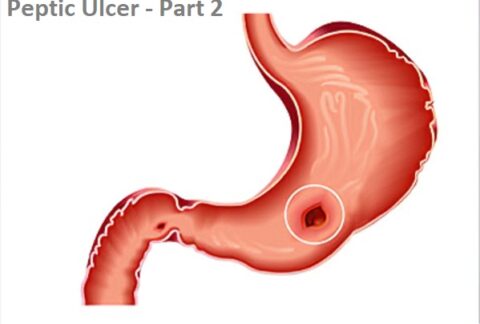peptic-ulcer-stomach