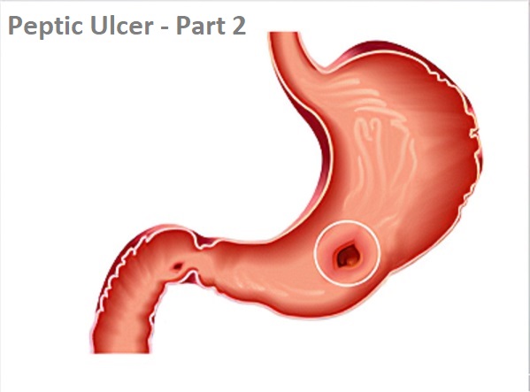 peptic-ulcer-stomach